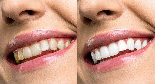 Teeth Whitening